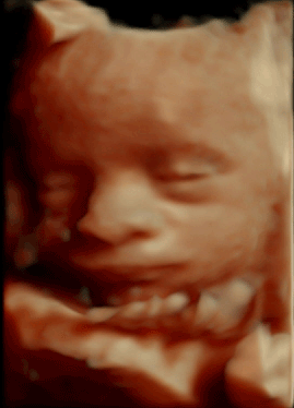 Baby 3D Ultraschall in der 30. SSW