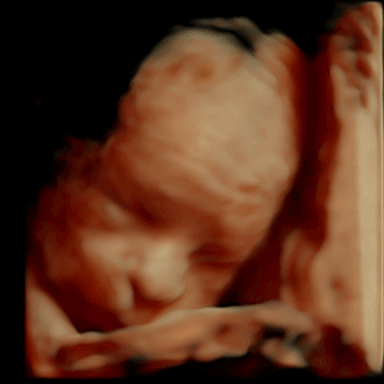 Baby 3D Ultraschall in der 26. SSW