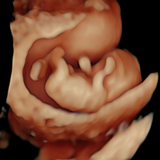 3D Ultraschall in der 11. Schwangerschaftswoche